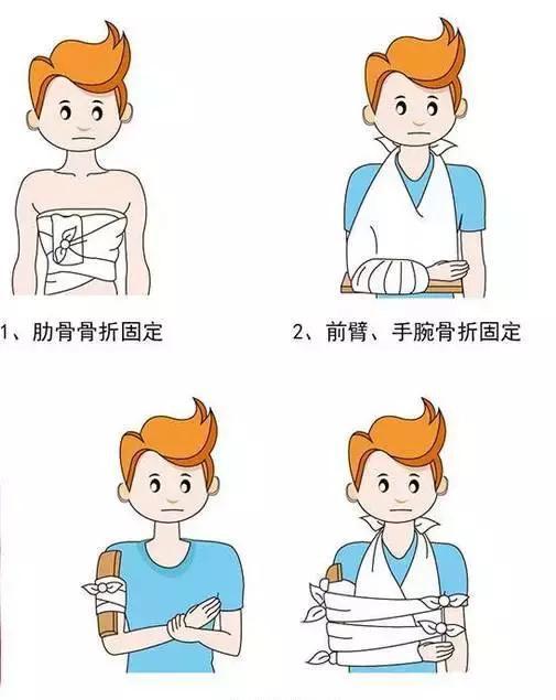 家庭骨折固定指南，全面解析如何正确应对骨折