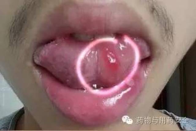 口腔溃疡疼痛急救指南，应对处理全攻略