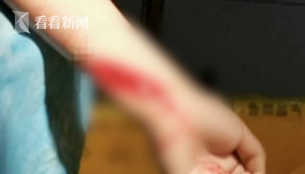 小儿跌倒后的急救与应急处理指南