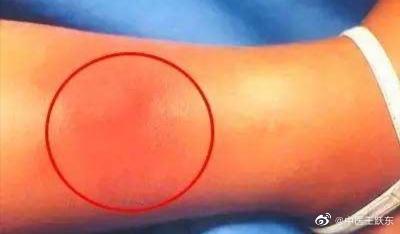 中医治疗头痛的常见方法简述