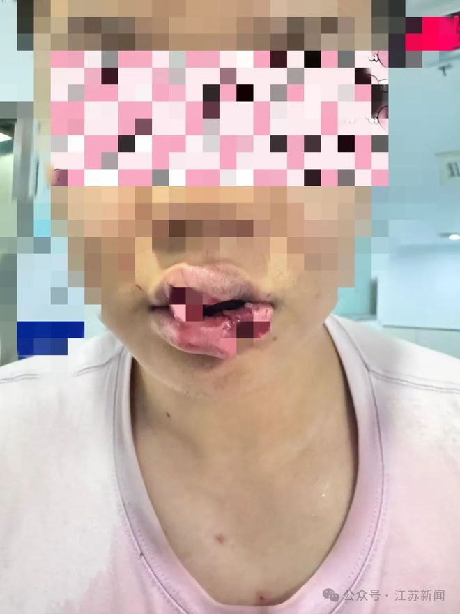 男子与爱宠亲密互动发生意外，嘴唇被咬掉引发教训与反思